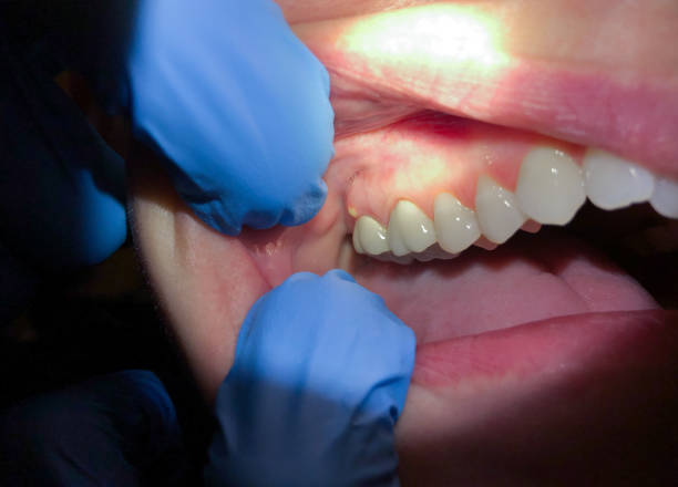 Best Knocked-Out Tooth (Avulsed Tooth) Treatment in New Johnsonville, TN
